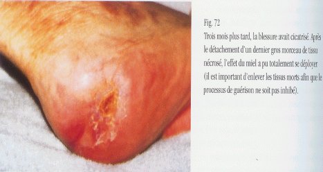 Détachement de la nécrose