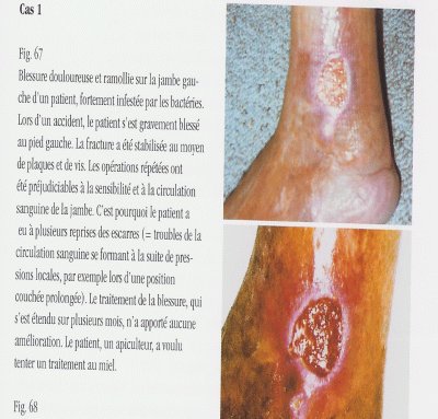Traitement au miel